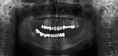 Floor Of Nasal Cavity Radiograph