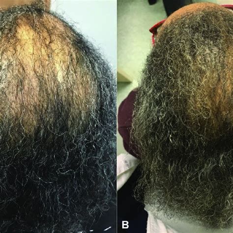 Improvement Of Central Centrifugal Cicatricial Alopecia After Download Scientific Diagram