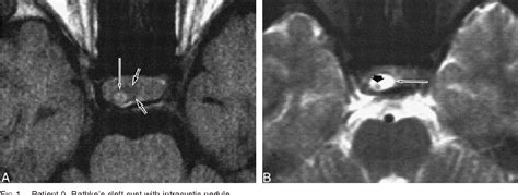 Figure From Mr Imaging Findings Of Rathke S Cleft Cysts Significance