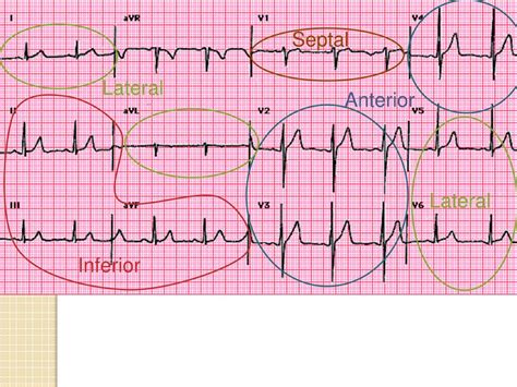 Ppt Ecg Interpretation For Beginners Part 4 Acute Coronary