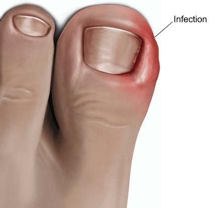 Do I Have Ingrown Toenails Arizona Foot Ankle Specialists