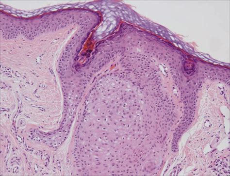 Multiple Facial Papules And Macrocephaly—quiz Case Congenital Defects