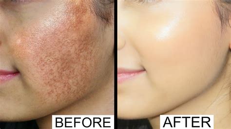 Hyper Pigmentation And Acne Scars Anaysa Youtube