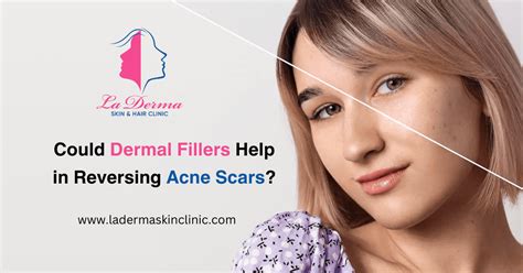 Fillers For Acne Scars: Cost, Procedure & Side Effects | La Derma Kolkata