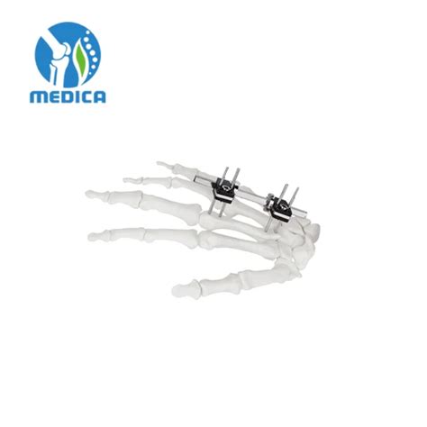 Orthopedic Trauma Surgery Single Sided Integrated External Fixation