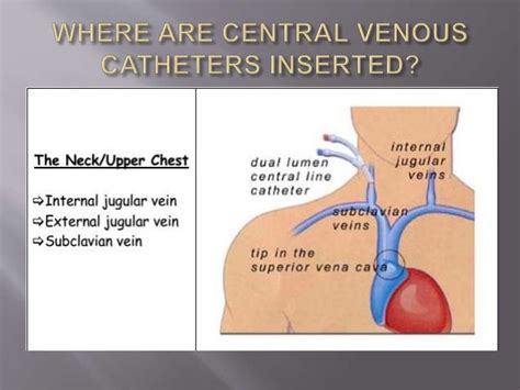 Central Venous Catheter