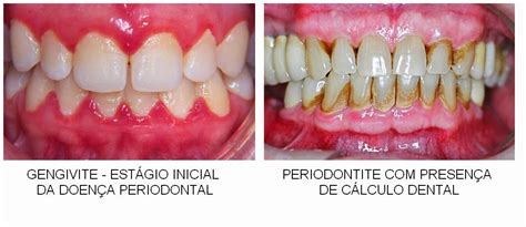 Kompleta Comunicação Doença de origem bucal pode ter relação direta