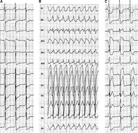 Case 1 A Baseline 12 Lead Ecg The Preexcitation Pattern Cannot Be