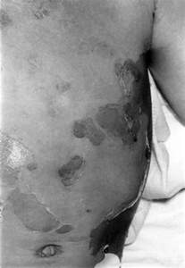 The Nikolsky Sign In Staphylococcal Scalded Skin Syndrome Archives Of