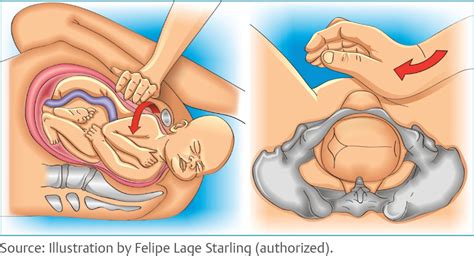 Scielo Brasil Management Of Shoulder Dystocia Management Of