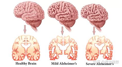 什么是阿尔兹海默症？如何防治？ 知乎