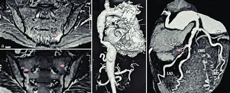 Patient 1 A And B Magnetic Resonance Imaging Of The Sacroiliac Joint Download Scientific