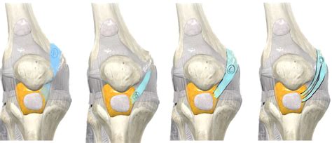 La Plica Sinovial De La Rodilla Ecograf A Anatom A Y Tratamientos