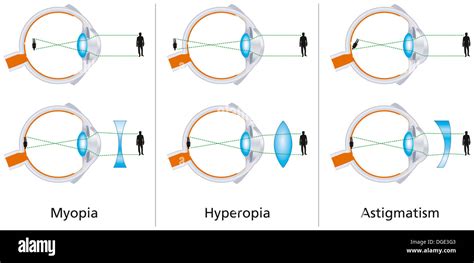 Visual Defects Myopia Hyperopia And Astigmatism Stock Photo Alamy