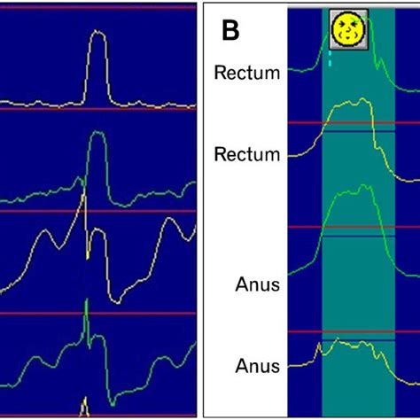 Pdf How To Interpret Conventional Anorectal Manometry