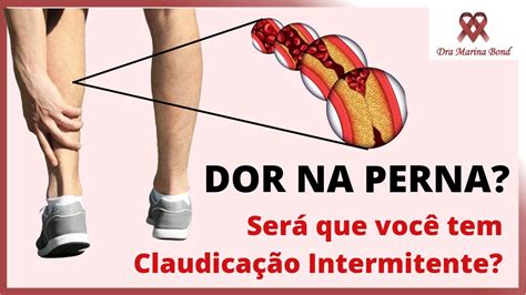 DOR nas PERNAS ao CAMINHAR Claudicação Intermitente Doença Arterial