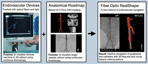 Three Dimensional Visualisation Of Endovascular Guidewires And