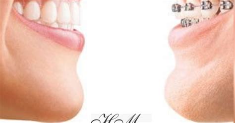 Hm Odontologia Em Ribeir O Pires Sorriso Saud Vel Dentes Tratados E