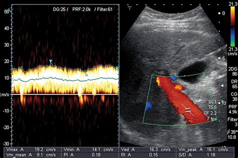 The Role Of Ultrasound In Portal Hypertension Radiology Key