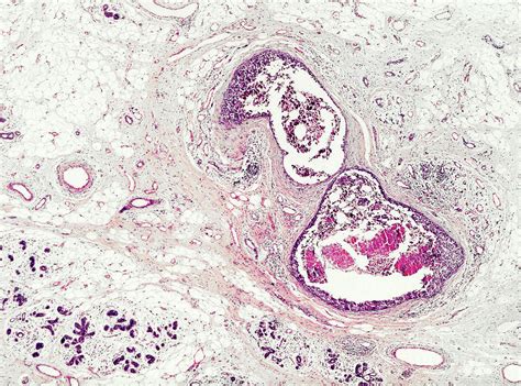 Scirrhous Carcinoma Of The Breast Photograph By Nigel Downer Science Photo Library Pixels