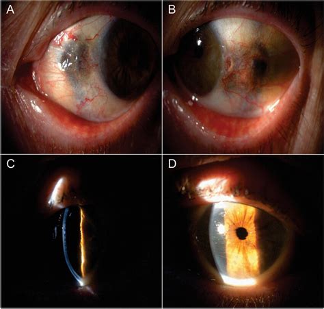 Clinical Appearance On Silt Lamp Biomicroscopy A Dark Conjunctival And Download Scientific