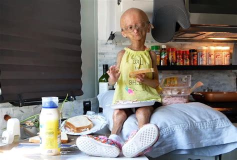 Falleció Adalia Rose La Youtuber Que Conmovió Por Su Envejecimiento