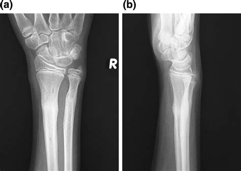 Plain Radiography On The Final Follow Up Bone Union Of The Radius And