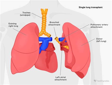 Lung Transplant Surgical Details And What To Expect