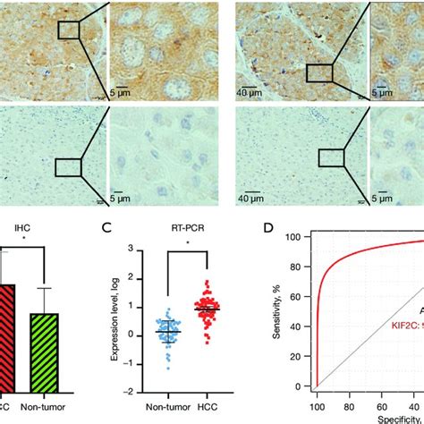 The Expression Level Of Kif2c In Hcc A Representative Ihc Staining