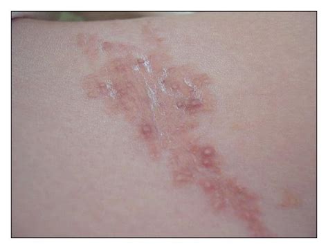 Multiple Pinkish Pearly Flesh Colored Papules Download Scientific