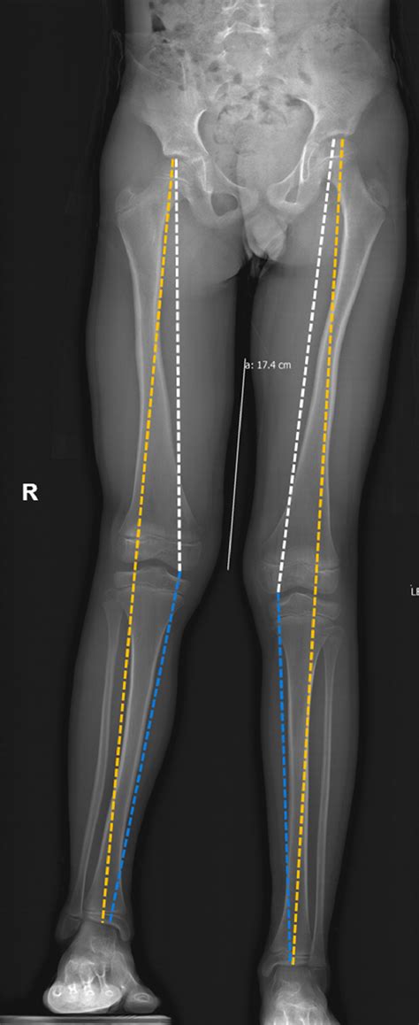 Can Radiology Technologists Be Trained To Measure Leg Length