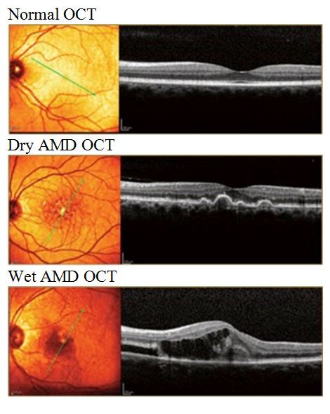 Wet Amd Vs Dry Amd