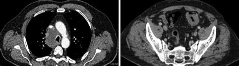 Axial Ct Thorax A With Contrast Showing A Lobulated 7 3 Cm Soft Download Scientific Diagram