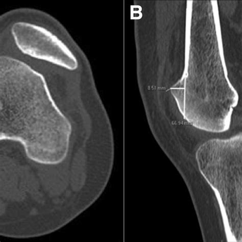 Dejour Classification Of Trochlear Dysplasia Note The 4 Morphological Download Scientific