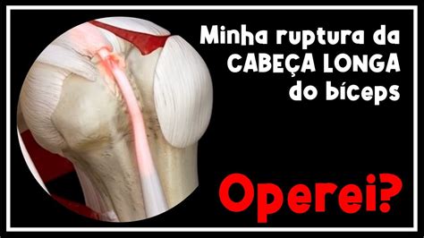 Minha Ruptura Da Cabe A Longa Do B Ceps Rotura Cabo Longo Youtube