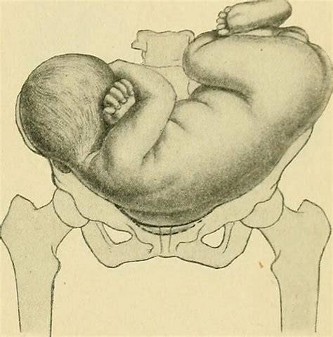 Shoulder Dystocia And Birth Injuries Your Legal Options Opln Law