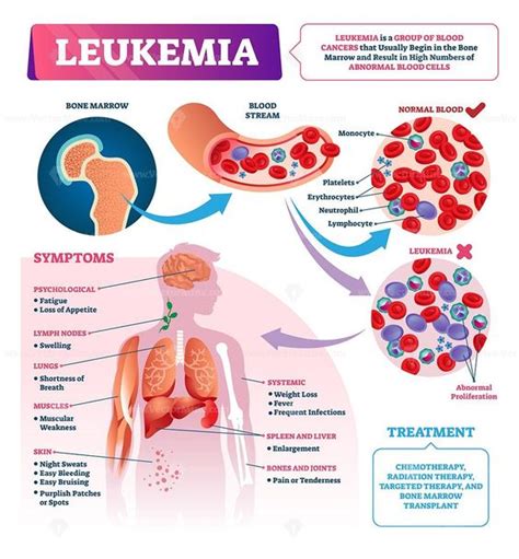 Leukemia Cancer Treatments, Causes & Symptoms - NHCancerClinics