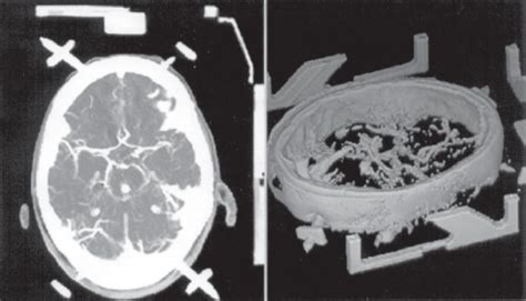 Angiotomograf A Cerebral Helicoidal Luego De Colocado El Marco