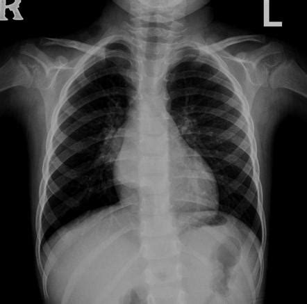 Bronchogenic Cyst Radiology Reference Article Radiopaedia Org