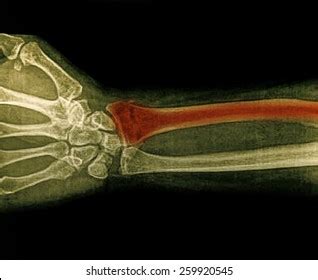 Film Xray Wrist Show Fracture Distal Stock Photo Shutterstock