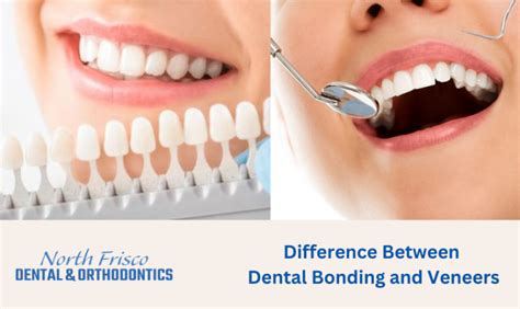 What Are The Difference Between Dental Bonding And Veneers