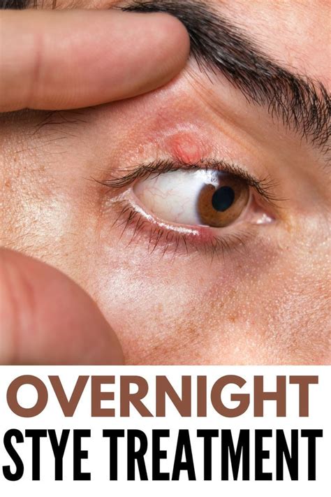 How to Get Rid of a Stye Overnight | Stye treatment, Stye, Swollen eyelids remedy