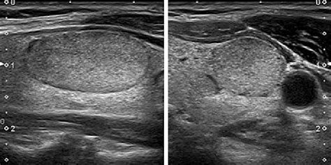 EU-TIRADS 3: low-risk isoechoic nodule with an oval shape and smooth... | Download Scientific ...