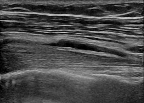 Musculoskeletal Joints And Tendons 61 Shoulder Case 611 Biceps