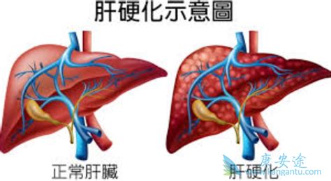 早期肝硬化症状表现通常有哪些？ 康安途海外医疗