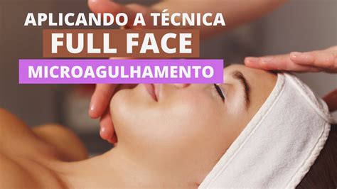 Microagulhamento Na Pr Tica Tecnica Full Face Youtube