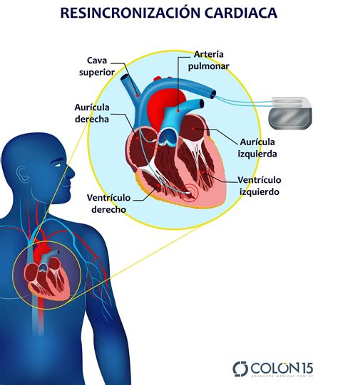 Control Y Revisi N De Dispositivos De Electroestimulaci N Cardiaca