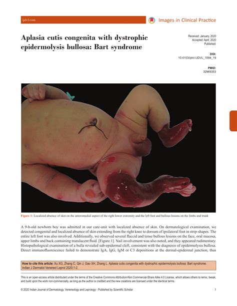 Pdf Aplasia Cutis Congenita With Dystrophic Epidermolysis Bullosa Bart Syndrome