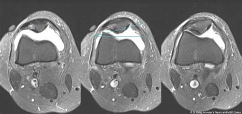 Dr Balaji Anvekar Frcr Excessive Lateral Pressure Syndrome Mri