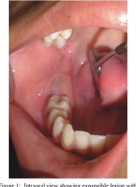 Figure From Conservative Management Of Unicystic Ameloblastoma In A